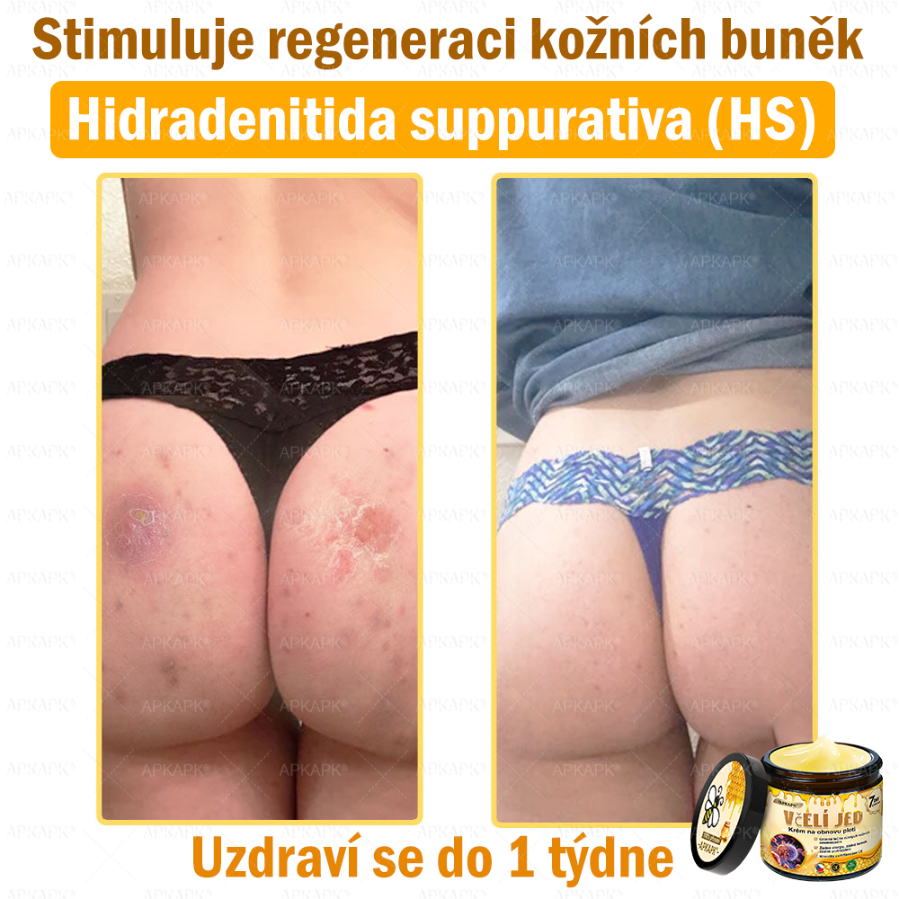 🐝Dermatologicky a klinicky testováno👩‍⚕️🐝APKAPK®Bee Venom Krém na obnovení pleti🐝 pomáhá při léčbě kožních problémů, jako jsou: vrásky, jizvy, pigmentové skvrny, strie, akné, psoriáza, ekzém, kožní změny, podráždění, záněty a další kožní problémy.