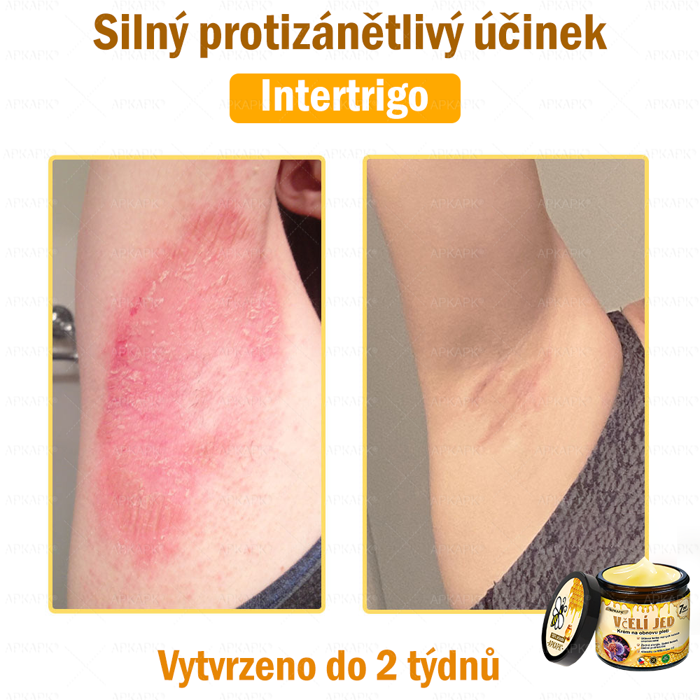 🐝Dermatologicky a klinicky testováno👩‍⚕️🐝APKAPK®Bee Venom Krém na obnovení pleti🐝 pomáhá při léčbě kožních problémů, jako jsou: vrásky, jizvy, pigmentové skvrny, strie, akné, psoriáza, ekzém, kožní změny, podráždění, záněty a další kožní problémy.