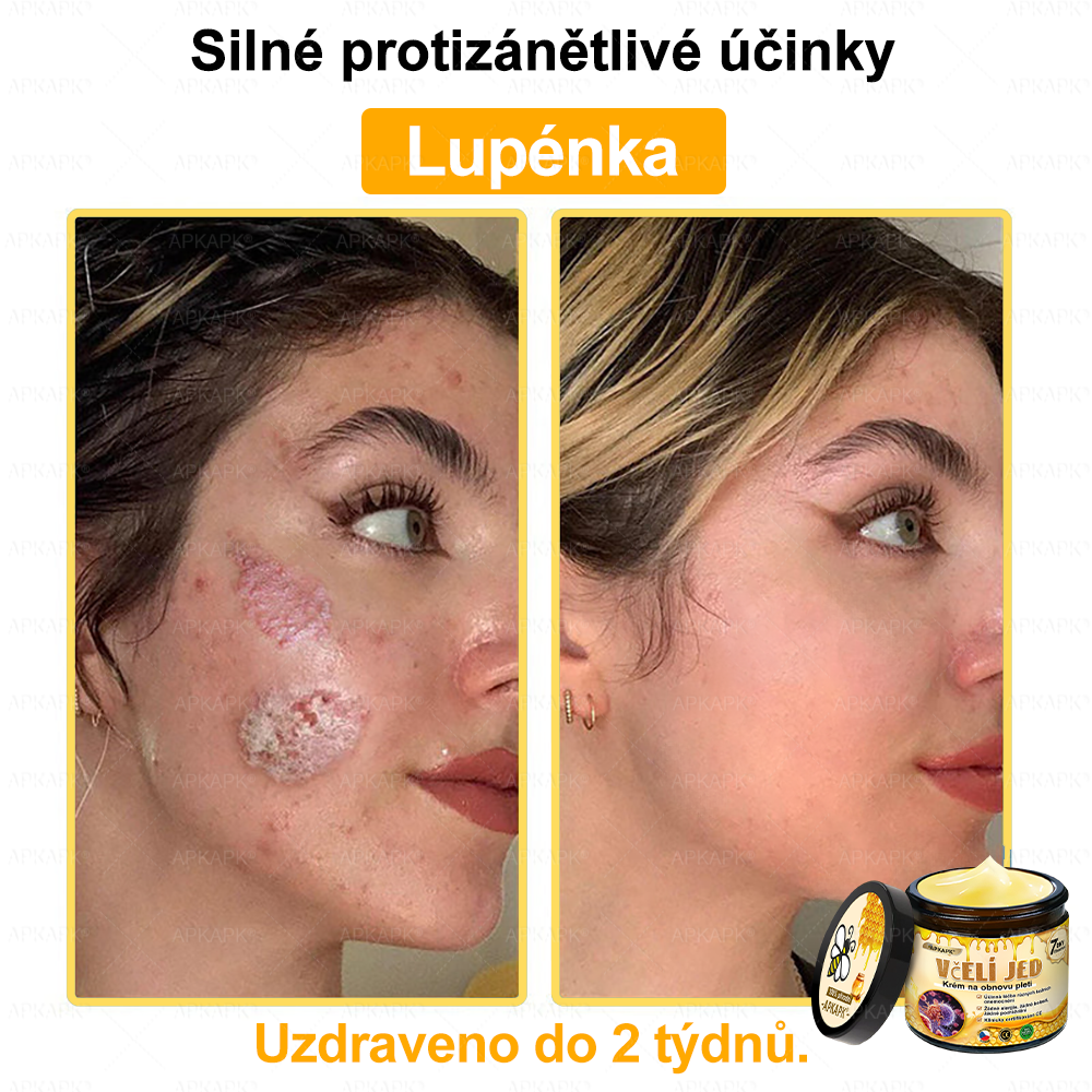 🐝Dermatologicky a klinicky testováno👩‍⚕️🐝APKAPK®Bee Venom Krém na obnovení pleti🐝 pomáhá při léčbě kožních problémů, jako jsou: vrásky, jizvy, pigmentové skvrny, strie, akné, psoriáza, ekzém, kožní změny, podráždění, záněty a další kožní problémy.