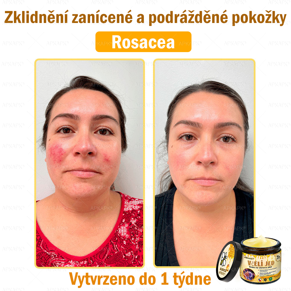 🐝Dermatologicky a klinicky testováno👩‍⚕️🐝APKAPK®Bee Venom Krém na obnovení pleti🐝 pomáhá při léčbě kožních problémů, jako jsou: vrásky, jizvy, pigmentové skvrny, strie, akné, psoriáza, ekzém, kožní změny, podráždění, záněty a další kožní problémy.