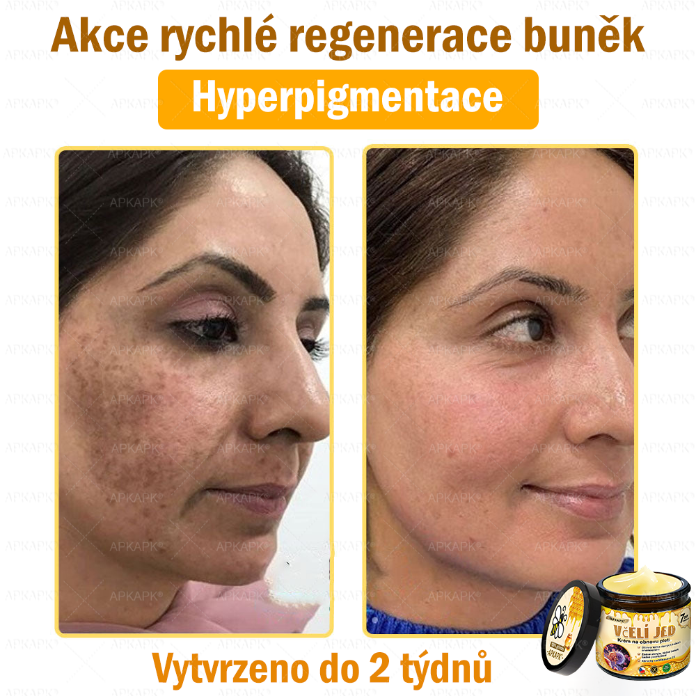 🐝Dermatologicky a klinicky testováno👩‍⚕️🐝APKAPK®Bee Venom Krém na obnovení pleti🐝 pomáhá při léčbě kožních problémů, jako jsou: vrásky, jizvy, pigmentové skvrny, strie, akné, psoriáza, ekzém, kožní změny, podráždění, záněty a další kožní problémy.